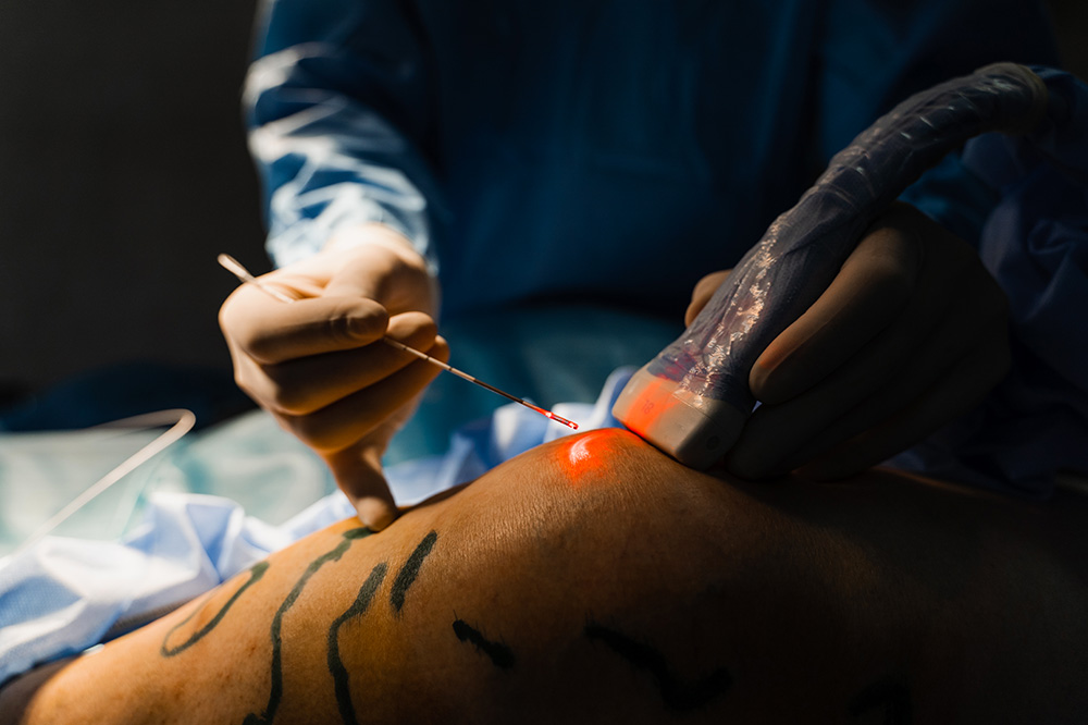 Traitement endoveineux par laser