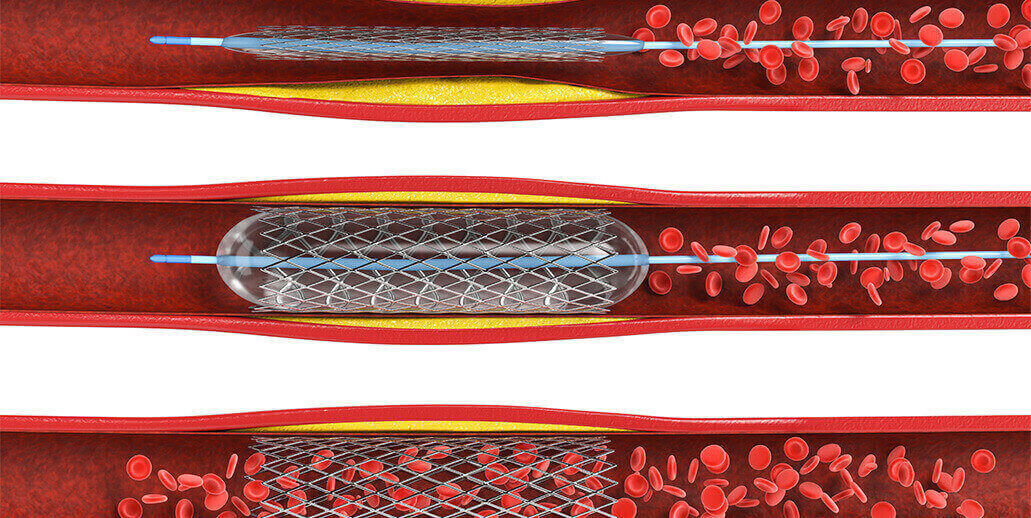 Stenting